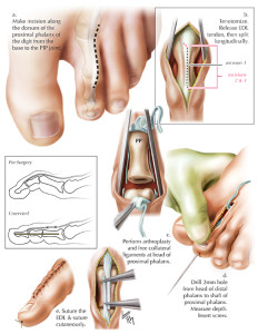 hammertoe layout5.4